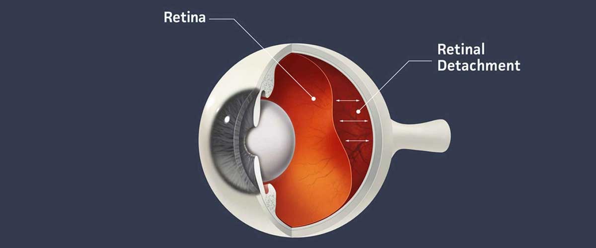 Retina Treatment in Kandivali
